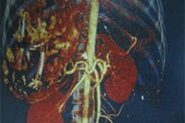 Một thai nhi sống trong... gan mẹ