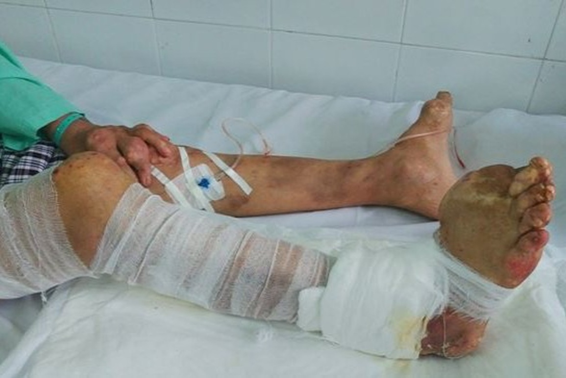 Vì sao nhiều người tại TPHCM phải nhập viện điều trị gút sau kỳ nghỉ Tết? - 1 Vì sao nhiều người tại TPHCM phải nhập viện điều trị gút sau kỳ nghỉ Tết? - 1