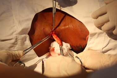 Phát hiện thanh gỗ dài 7cm nằm sâu trong cổ 