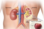 Phát hiện ung thư thận như thế nào?