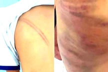 Khởi tố vụ án bé trai lớp 1 mang 20 vết bầm tím trên cơ thể