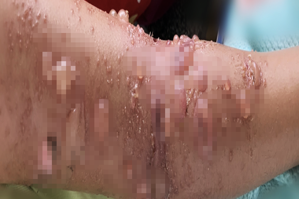 TPHCM: Hàng loạt người vào viện cầu cứu vì đi tắm biển gặp họa bỏng sứa - 2 TPHCM: Hàng loạt người vào viện cầu cứu vì đi tắm biển gặp họa bỏng sứa - 2