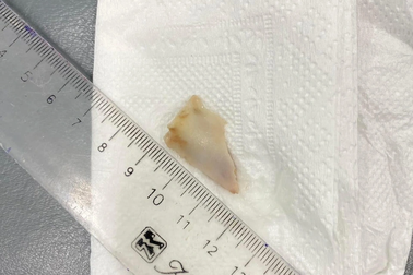 Ăn thịt lợn, người đàn ông nhập viện cấp cứu vì lý do khó ngờ