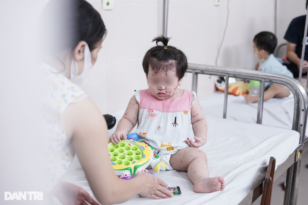 Tay chân miệng tại Hà Nội vào đỉnh dịch: Triệu chứng nguy hiểm nhất - 1 Tay chân miệng tại Hà Nội vào đỉnh dịch: Triệu chứng nguy hiểm nhất - 1
