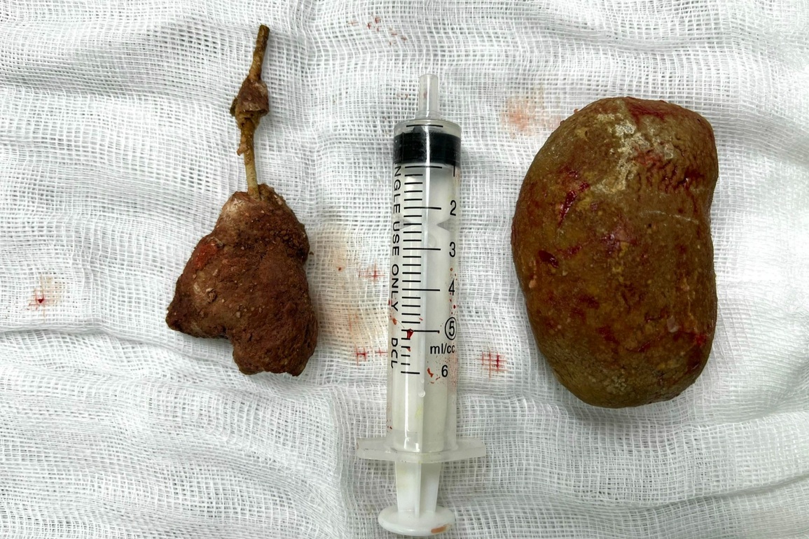 Sỏi to như quả trứng gà trong bàng quang người đàn ông 27 tuổi - 2 Sỏi to như quả trứng gà trong bàng quang người đàn ông 27 tuổi - 2