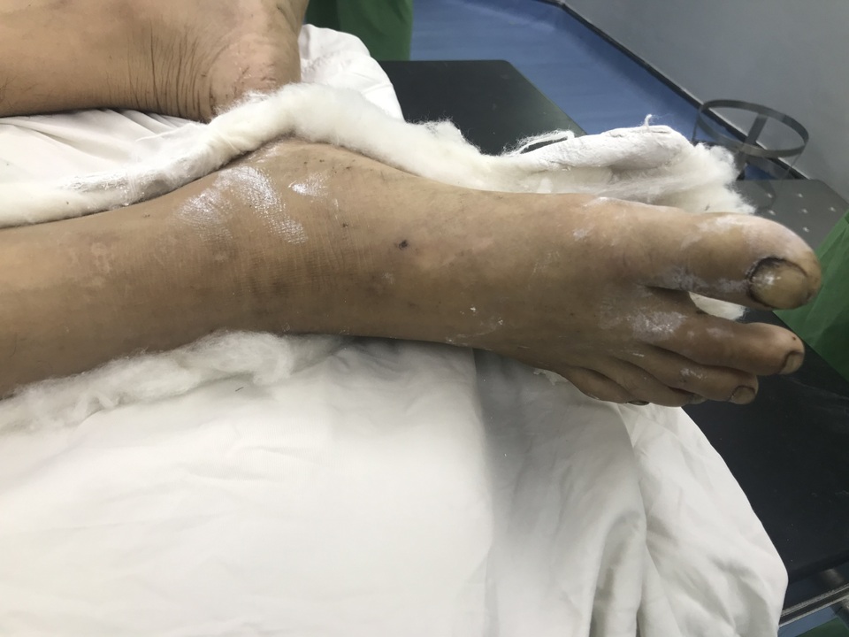 Bác sĩ về tận địa phương cứu bệnh nhân bị máy cắt nát chân - 1 Bác sĩ về tận địa phương cứu bệnh nhân bị máy cắt nát chân - 1