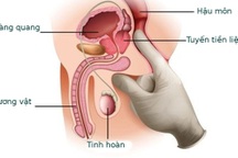 Tất cả những điều cần biết về ung thư tuyến tiền liệt