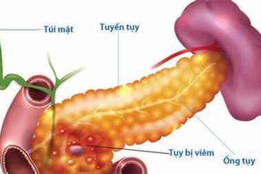 Điều bạn nhất định phải biết khi ăn để bảo vệ tuyến tụy