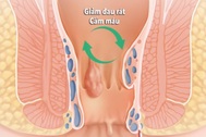 Bệnh trĩ - Cách phòng tránh và chữa trị
