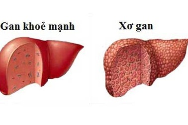 80% bệnh nhân ung thư gan có viêm gan virus B, C