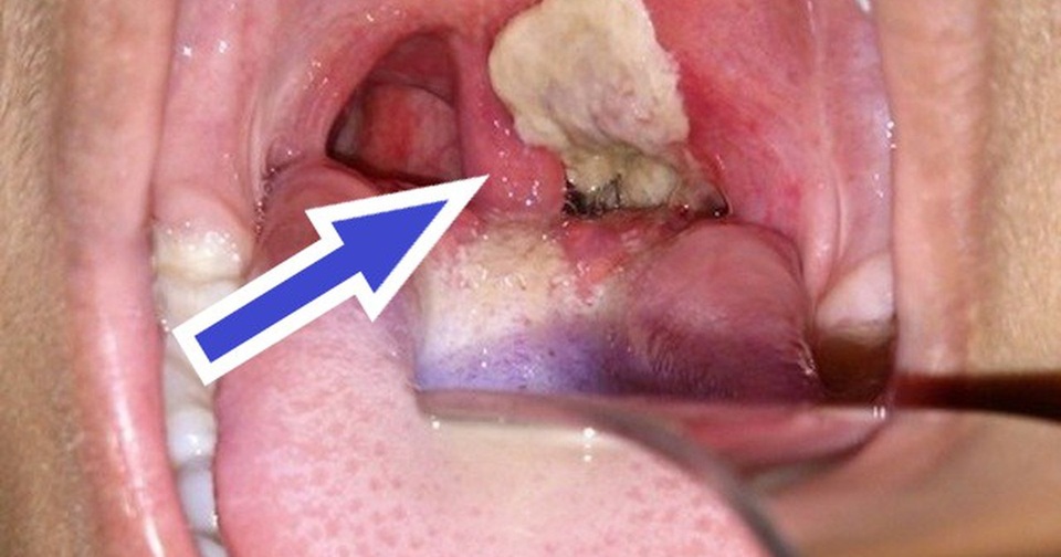 Cả nước vượt mốc 65.000 ca sốt xuất huyết, 7 người tử vong - 4 Cả nước vượt mốc 65.000 ca sốt xuất huyết, 7 người tử vong - 4