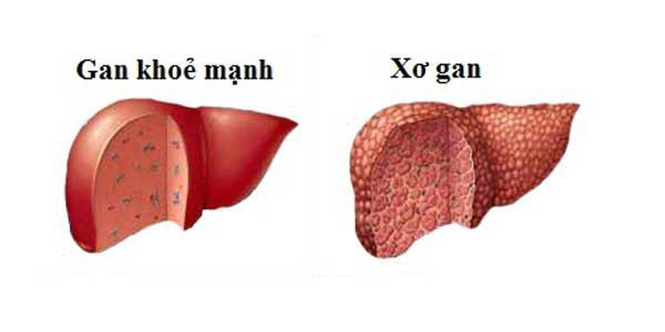 80% bệnh nhân ung thư gan có viêm gan virus B, C - 1 80% bệnh nhân ung thư gan có viêm gan virus B, C - 1
