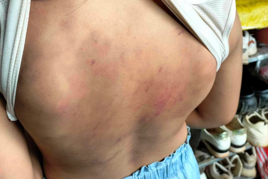 Nữ sinh lớp 4 nhập viện, khủng hoảng vì bị 10 bạn cùng lớp đánh hội đồng - 1 Nữ sinh lớp 4 nhập viện, khủng hoảng vì bị 10 bạn cùng lớp đánh hội đồng - 1