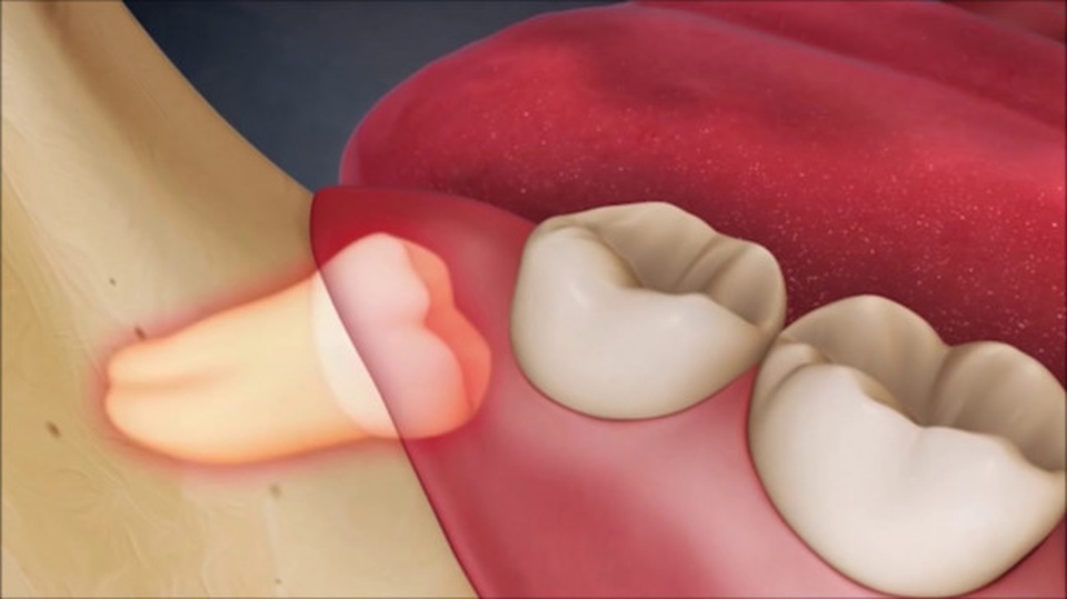 Răng số 8 biến chứng có thể là vấn đề của … ung thư - 1 Răng số 8 biến chứng có thể là vấn đề của … ung thư - 1