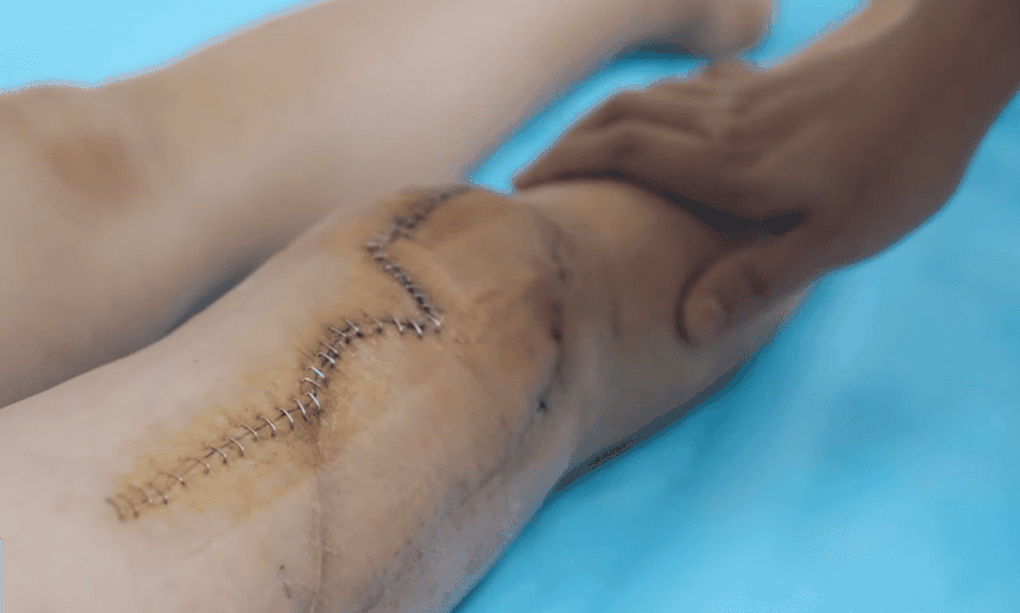 Kỳ tích phục hồi của đôi chân bị nhiễm trùng hoại tử suốt 2 năm - 1 Kỳ tích phục hồi của đôi chân bị nhiễm trùng hoại tử suốt 2 năm - 1