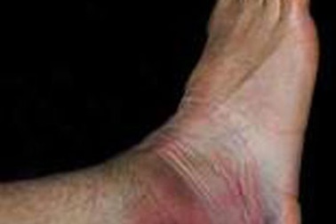 Đừng xoa mật gấu, đắp lá khi bong gân!