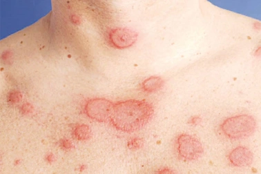 Sau Covid-19, tỷ lệ mắc bệnh tự miễn tăng cao