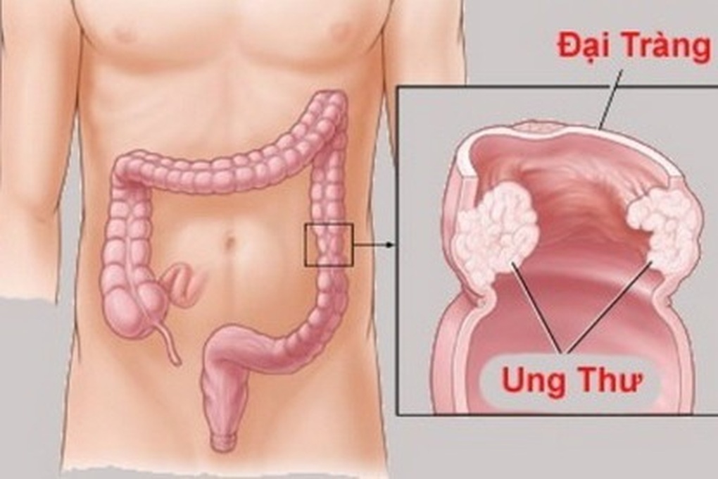 Đi ngoài ra máu tưởng trĩ tái phát không ngờ mắc ung thư - 1 Đi ngoài ra máu tưởng trĩ tái phát không ngờ mắc ung thư - 1
