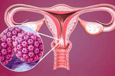 Cứ nhiễm HPV là có nguy cơ ung thư cổ tử cung?