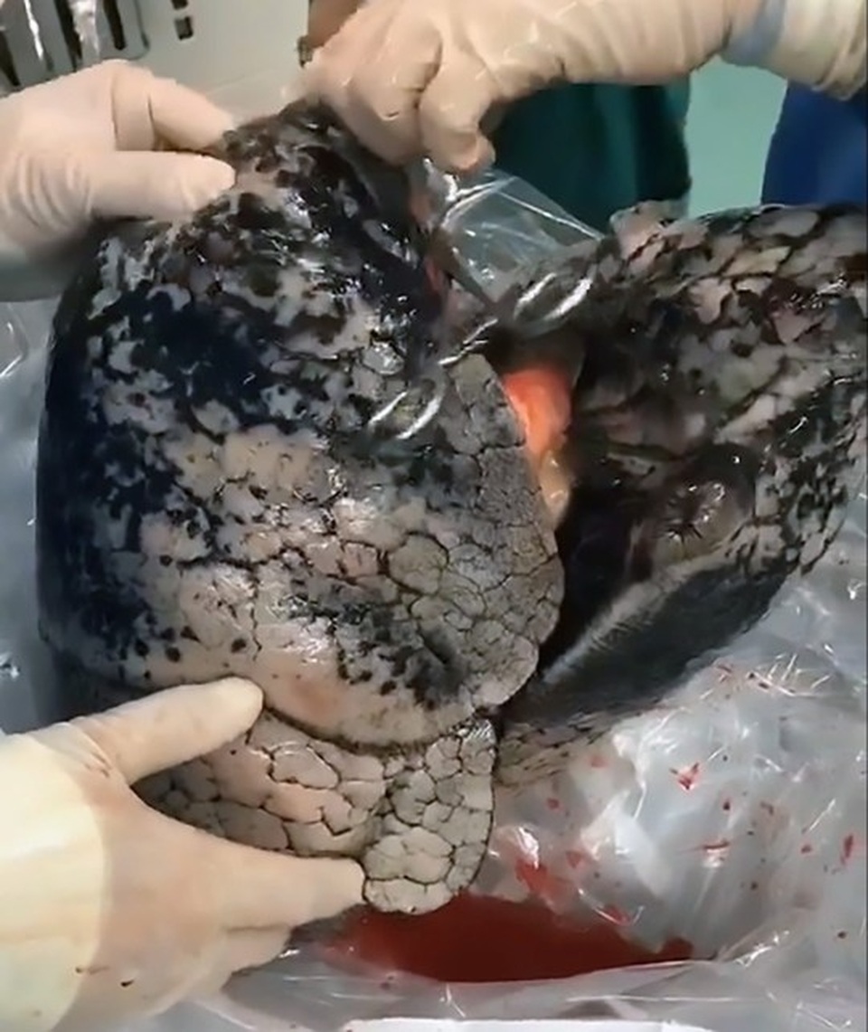 “Ám ảnh” lá phổi đen kịt của người 30 năm nghiện thuốc lá - 3 “Ám ảnh” lá phổi đen kịt của người 30 năm nghiện thuốc lá - 3