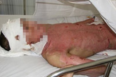 Bỏng nặng do bất cẩn 