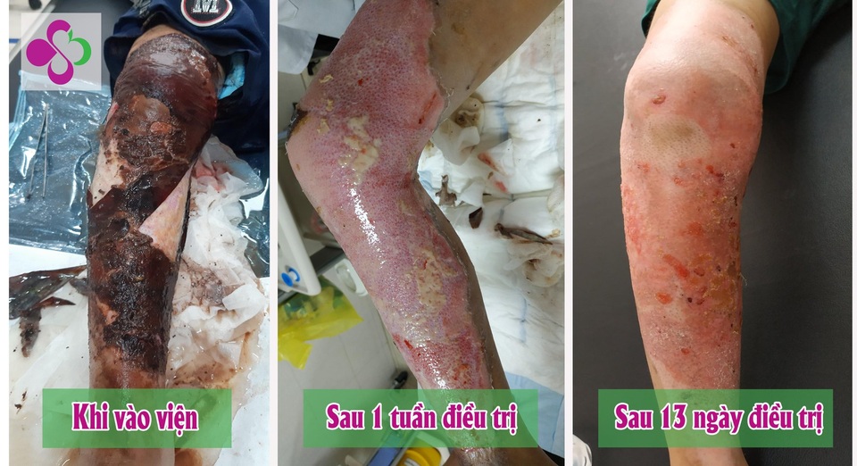 Dùng thuốc đỏ sát trùng vết bỏng, bé trai 7 tuổi hoại tử vùng đùi - 1 Dùng thuốc đỏ sát trùng vết bỏng, bé trai 7 tuổi hoại tử vùng đùi - 1
