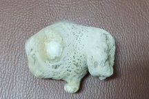 Viên sỏi “khủng” nằm trong thận của bệnh nhân bị thận móng ngựa