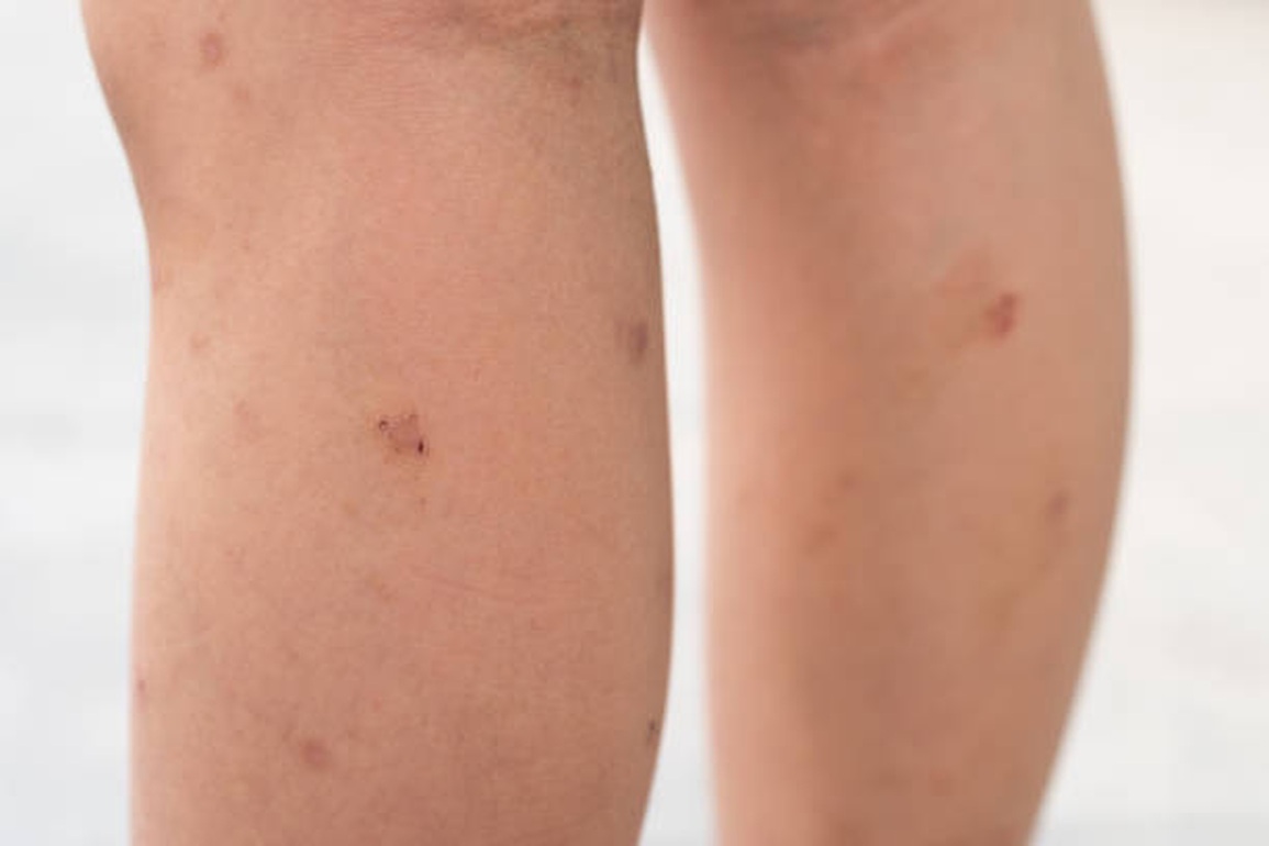 Loại virus gây ung thư sarcoma Kaposi - 2 Loại virus gây ung thư sarcoma Kaposi - 2
