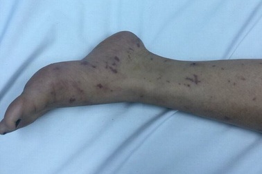 Thiếu nữ Hà Nội 15 tuổi bị vi khuẩn ‘ăn’ não, cách ly 14 người