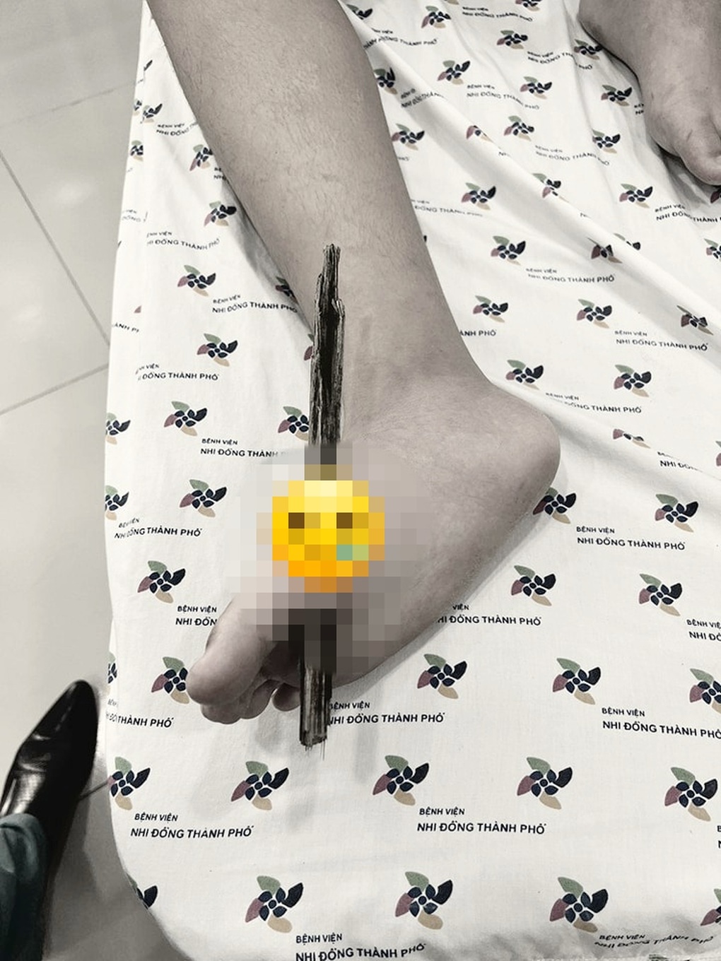 Nghỉ hè về quê ngoại tắm sông, bé trai 8 tuổi bị cây đâm xuyên chân - 1 Nghỉ hè về quê ngoại tắm sông, bé trai 8 tuổi bị cây đâm xuyên chân - 1