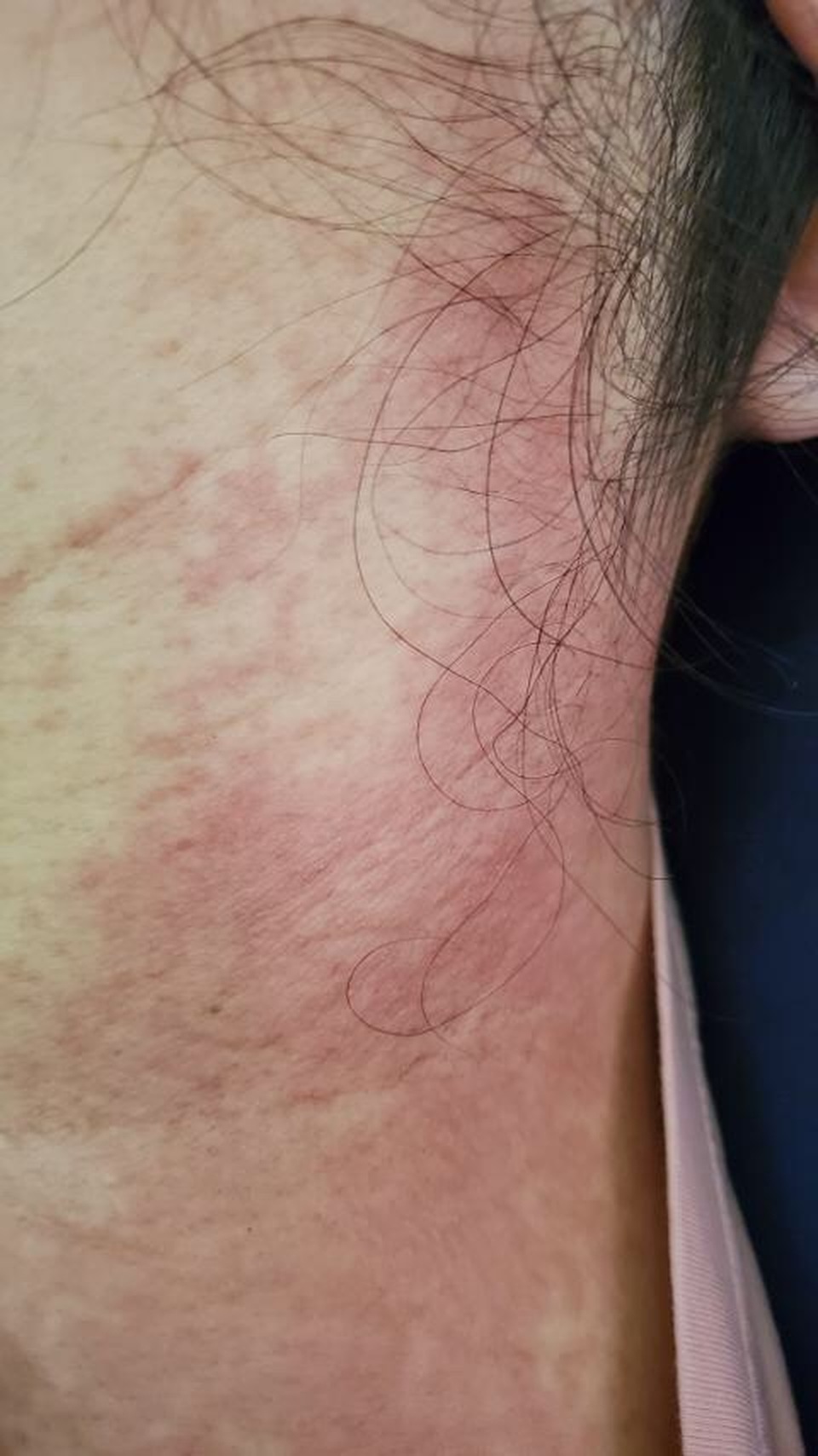 Thoa rượu gừng làm đẹp sau sinh, sản phụ nổi mẩn ngứa toàn thân - 1 Thoa rượu gừng làm đẹp sau sinh, sản phụ nổi mẩn ngứa toàn thân - 1