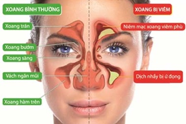 Làm gì khi nghẹt mũi xoang?
