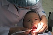 Sâu răng - Căn bệnh chung của trẻ em toàn cầu