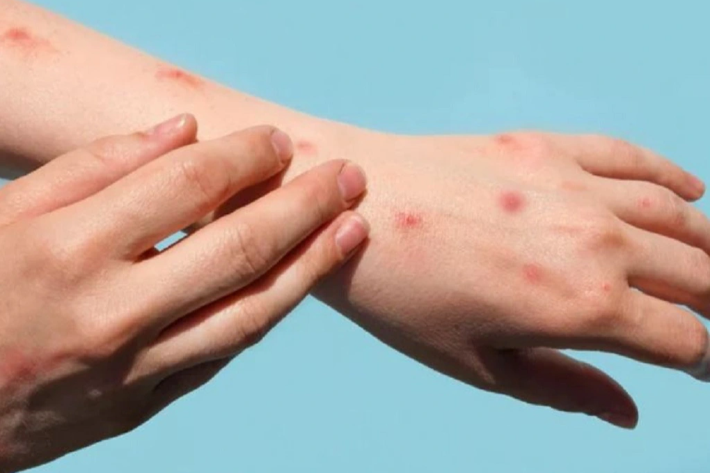 Đậu mùa khỉ là tình trạng khẩn cấp toàn cầu: 4 vấn đề quan trọng cần biết - 2 Đậu mùa khỉ là tình trạng khẩn cấp toàn cầu: 4 vấn đề quan trọng cần biết - 2