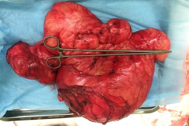 Tưởng béo bụng hóa khối u mạc treo ruột nặng 5kg