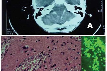 Bộ Y tế xác nhận bệnh nhi 6 tuổi tử vong vì “amíp ăn não”