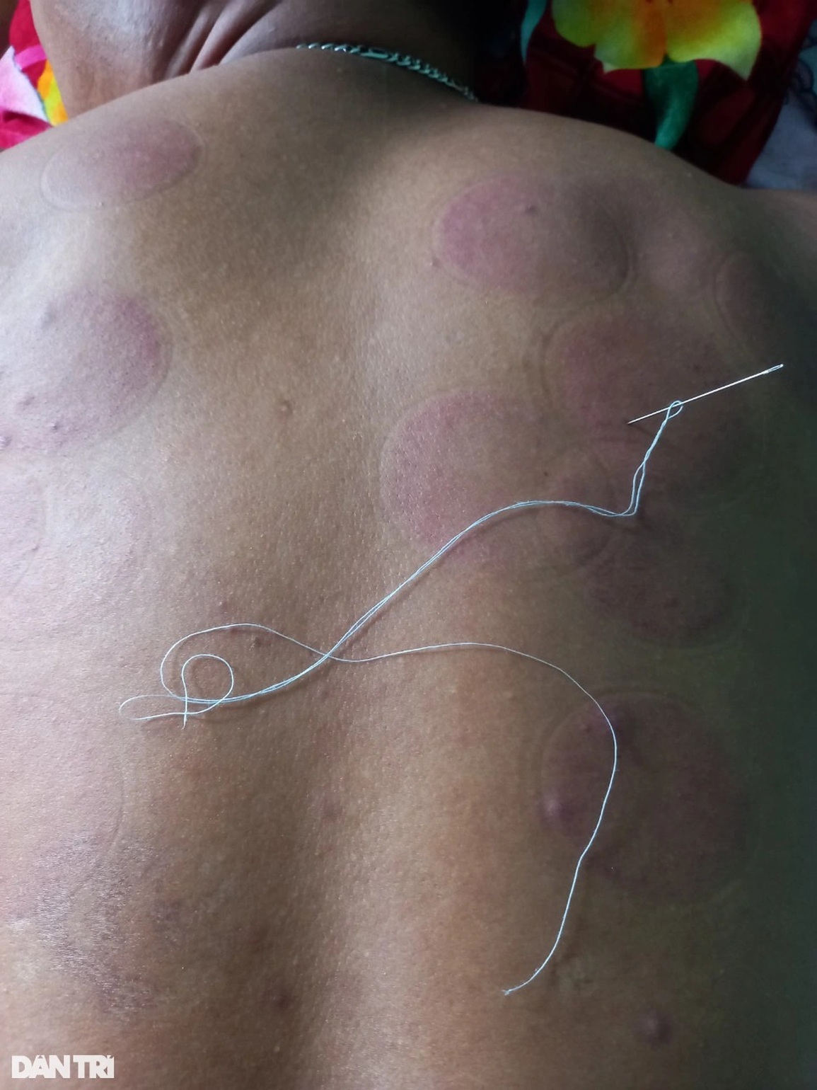 Rơi nước mắt cảnh cha bỏ điều trị, nhường sự sống cho con gái hở van tim - 4 Rơi nước mắt cảnh cha bỏ điều trị, nhường sự sống cho con gái hở van tim - 4