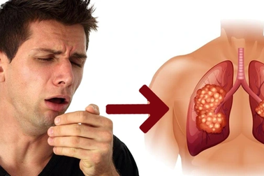 Vì sao nhóm người sau cần phải tầm soát ung thư phổi định kỳ?