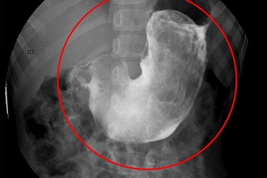 Bé gái đau bụng và hội chứng nghiện ăn tóc