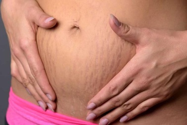 Kem ngừa rạn Amella: Để chị em không còn những lắng lo về “rạn”