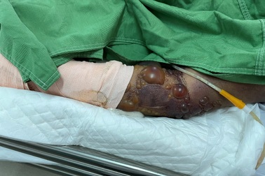 Hai nạn nhân đi cắt lá sả bị rắn cắn dẫn đến hôn mê