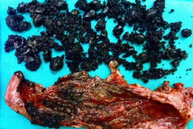 Phẫu thuật thành công ca viêm túi mật trước nguy cơ hoại tử