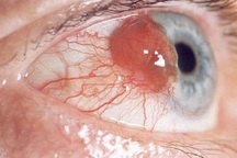 Những tiến bộ trong điều trị ung thư mắt