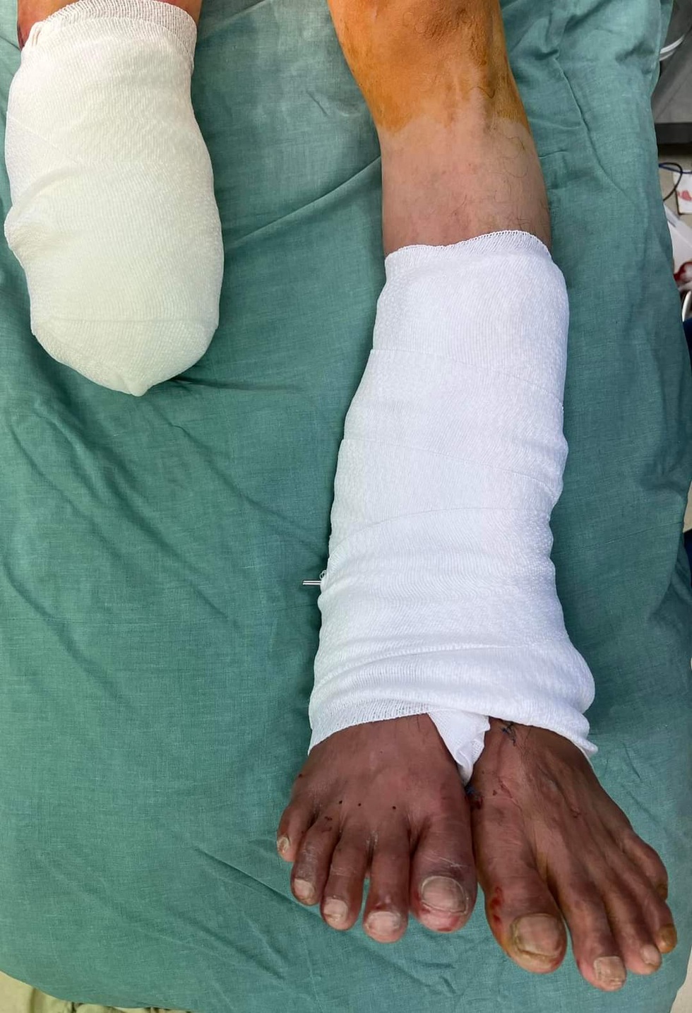 Tâm sự nghề nghiệp sau ca ghép chân đầu tiên tại Việt Nam - 1 Tâm sự nghề nghiệp sau ca ghép chân đầu tiên tại Việt Nam - 1