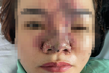 Thêm cô gái hỏng mũi, biến dạng mặt sau khi tiêm filler ở thẩm mỹ viện
