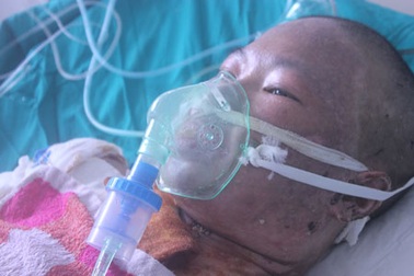 Bỏng gas hơn 50% cơ thể, tính mạng người mẹ trẻ nguy kịch