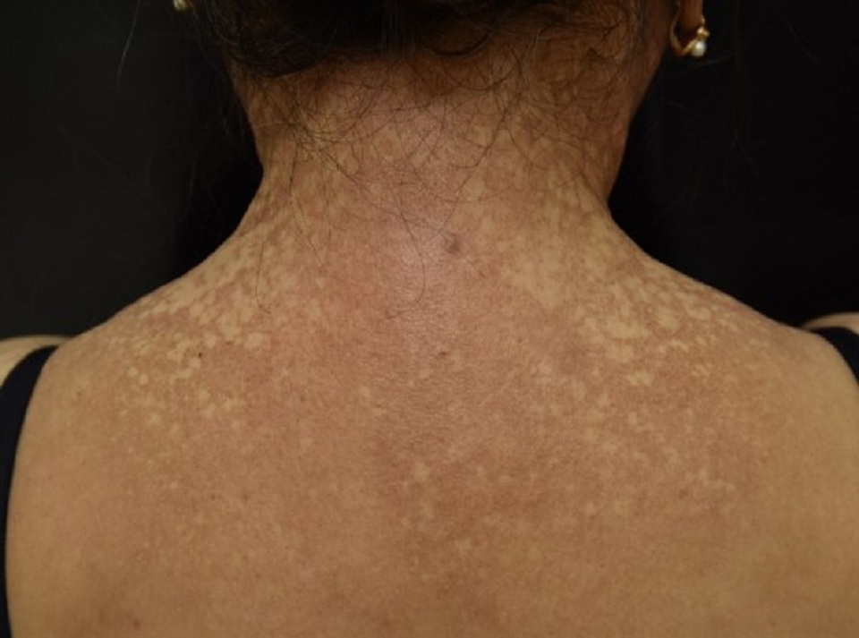 Nữ bệnh nhân bỗng nhiên đen sạm da, nửa đầu rụng hết tóc - 3 Nữ bệnh nhân bỗng nhiên đen sạm da, nửa đầu rụng hết tóc - 3