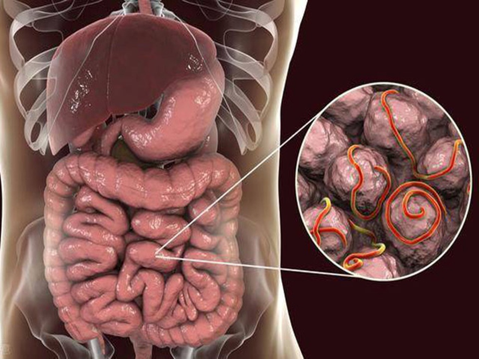 5 dấu hiệu tưởng vô hại nhưng lại là tín hiệu ung thư ruột phát triển - 1 5 dấu hiệu tưởng vô hại nhưng lại là tín hiệu ung thư ruột phát triển - 1