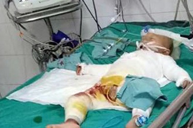 Ngã vào nồi nước chè đang sôi, bé 18 tháng tuổi bị bỏng nặng