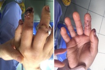 Dập nát ngón tay vì máy xay sinh tố